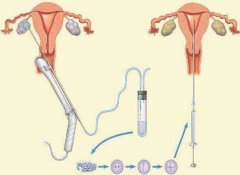 安庆借卵生子流程以及注意事项