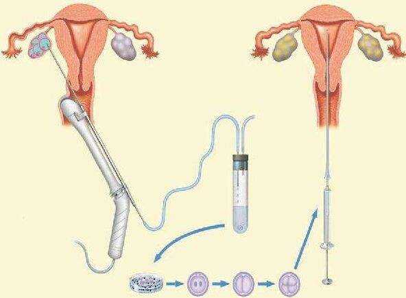 淮安市借卵机构借卵流程是什么？需要注意什么？